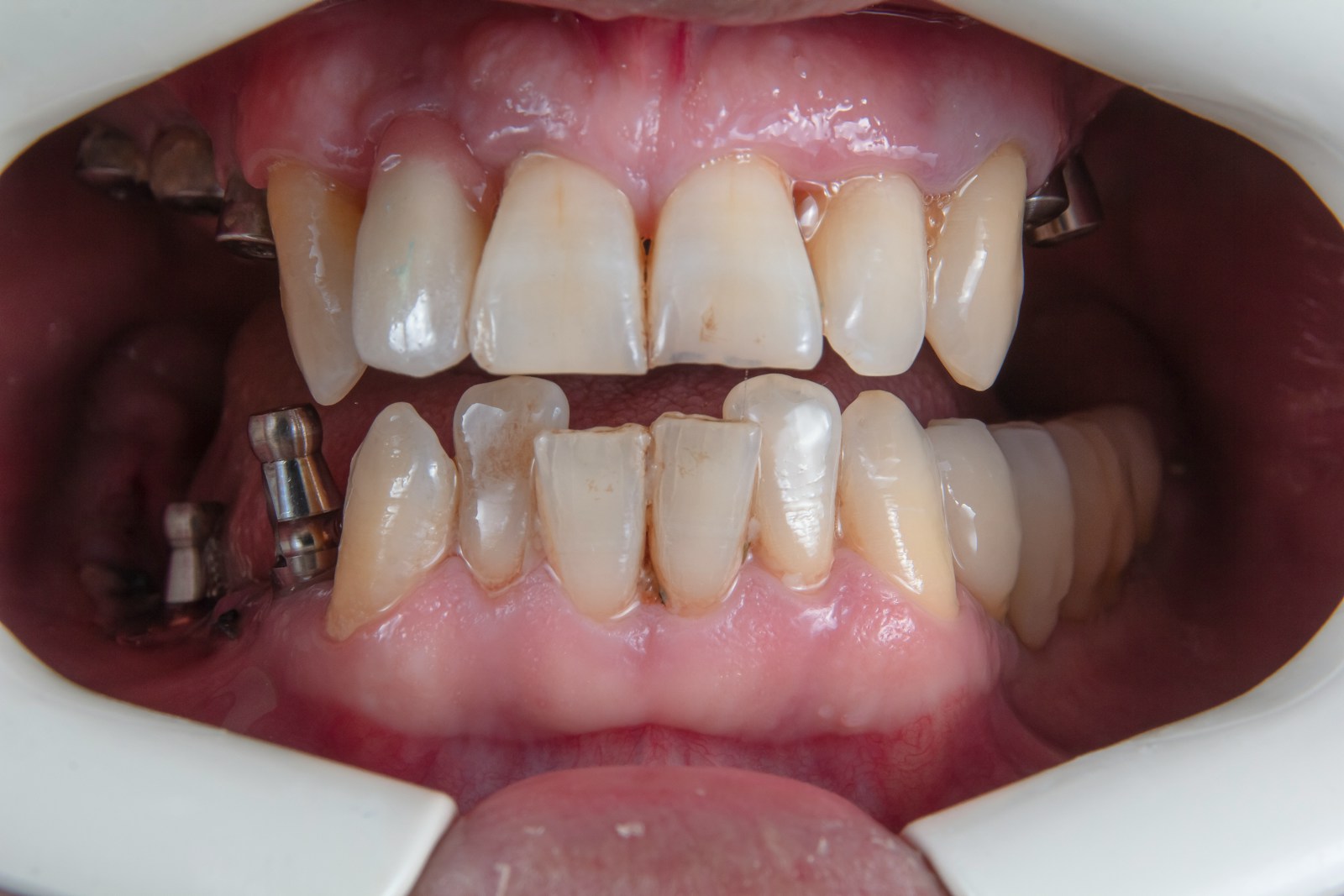 a person's mouth with teeth and tongue